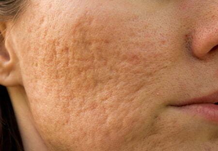 اسکار پوستی چیست؟ 7 روش خانگی درمان
